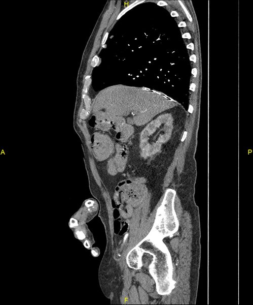 File:Aortoenteric fistula (Radiopaedia 84308-99603 C 104).jpg