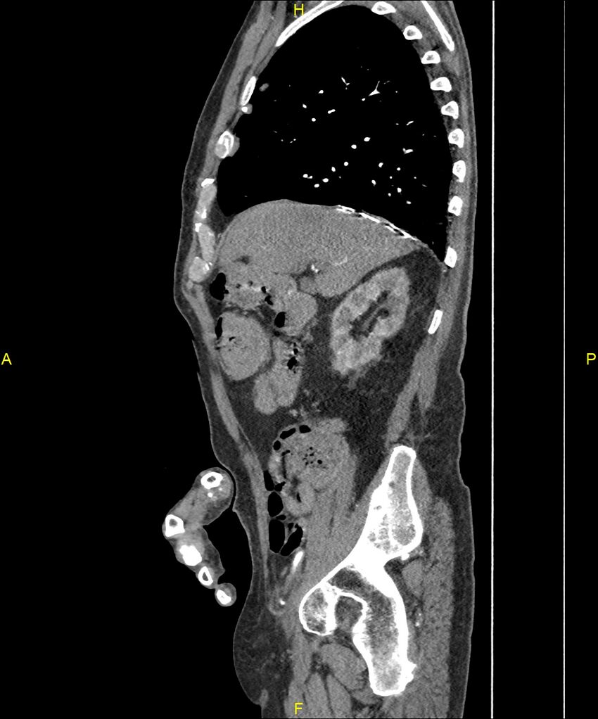 Aortoenteric fistula (Radiopaedia 84308-99603 C 104).jpg