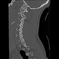Apical pneumothorax on cervical spine CT (Radiopaedia 45343-49368 Sagittal bone window 26).jpg