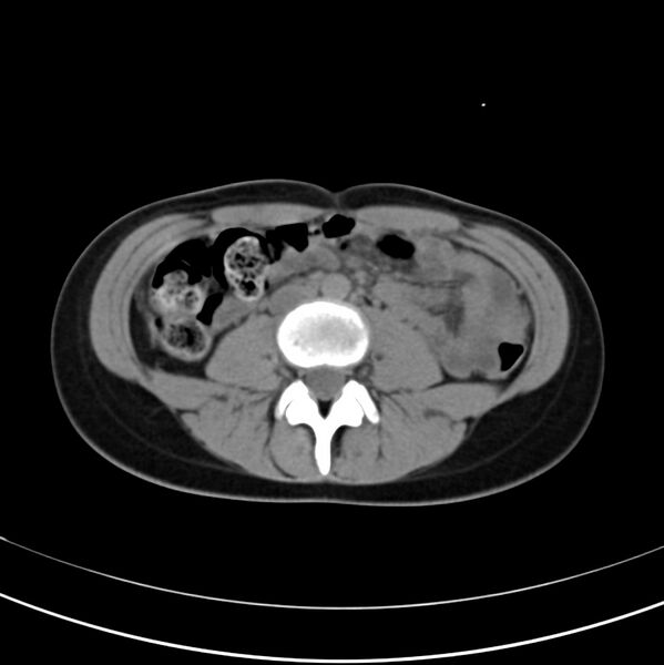 File:Appendicitis and incidental bicornuate uterus (Radiopaedia 22833-22853 Axial non-contrast 24).jpg