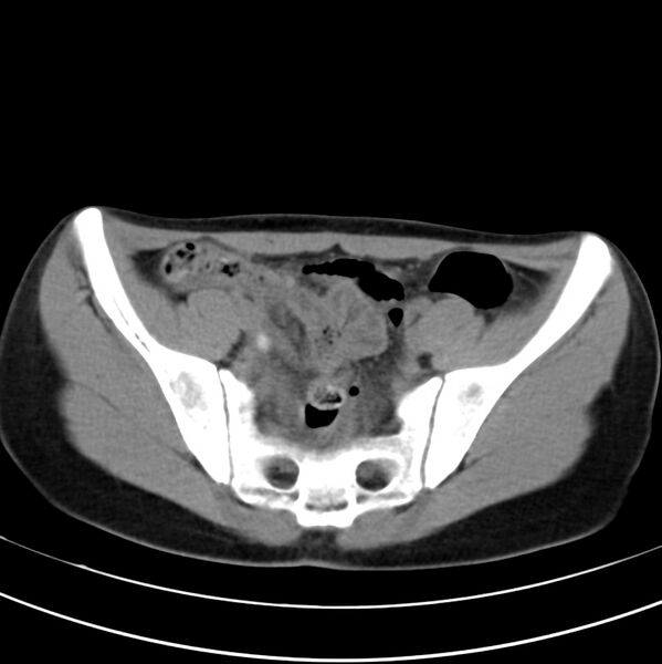 File:Appendicitis and incidental bicornuate uterus (Radiopaedia 22833-22853 Axial non-contrast 36).jpg