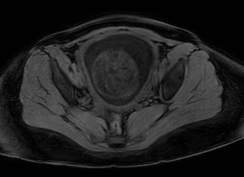 File:Appendicitis in gravida (MRI) (Radiopaedia 89433-106395 Axial DIXON 126).jpg