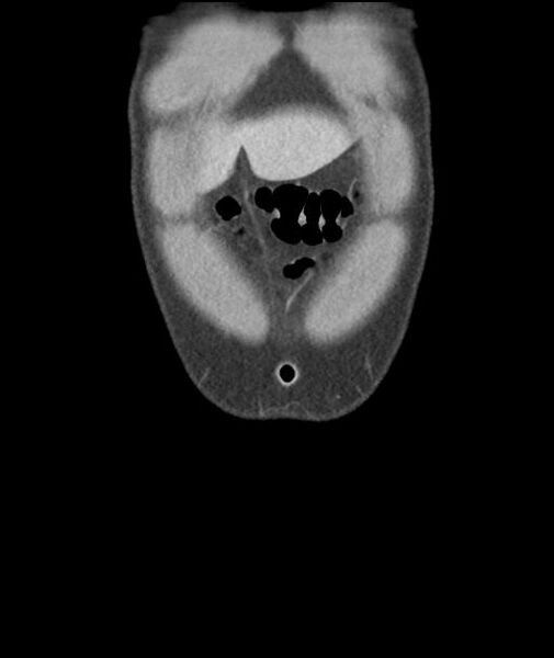 File:Appendicitis with cecal bar sign (Radiopaedia 31878-32830 A 9).jpg