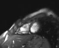 Arrhythmogenic right ventricular cardiomyopathy (Radiopaedia 69564-79464 short axis cine 37).jpg