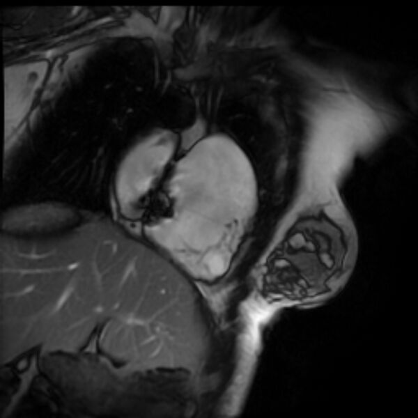 File:Arrhythmogenic right ventricular cardiomyopathy (Radiopaedia 87505-103850 2ch (RV) Cine SSFP 66).jpg