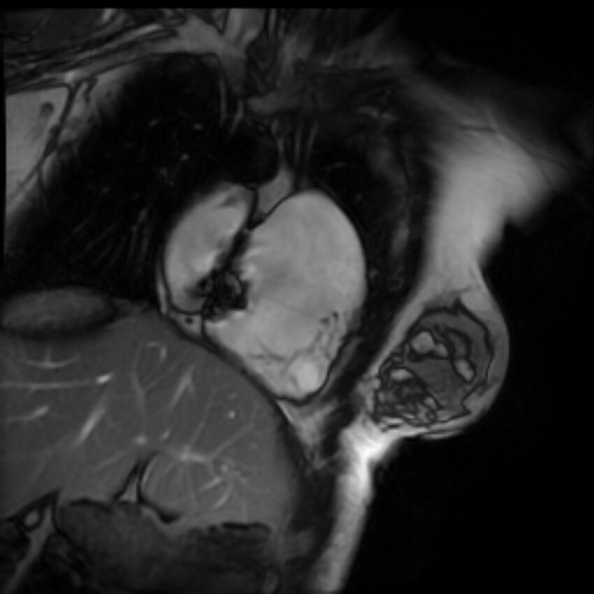 Arrhythmogenic right ventricular cardiomyopathy (Radiopaedia 87505-103850 2ch (RV) Cine SSFP 66).jpg