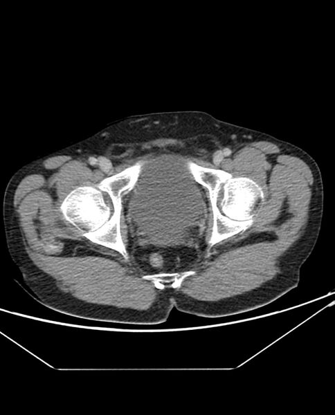 File:Arterial occlusive mesenteric ischemia (Radiopaedia 84641-100054 A 114).jpg