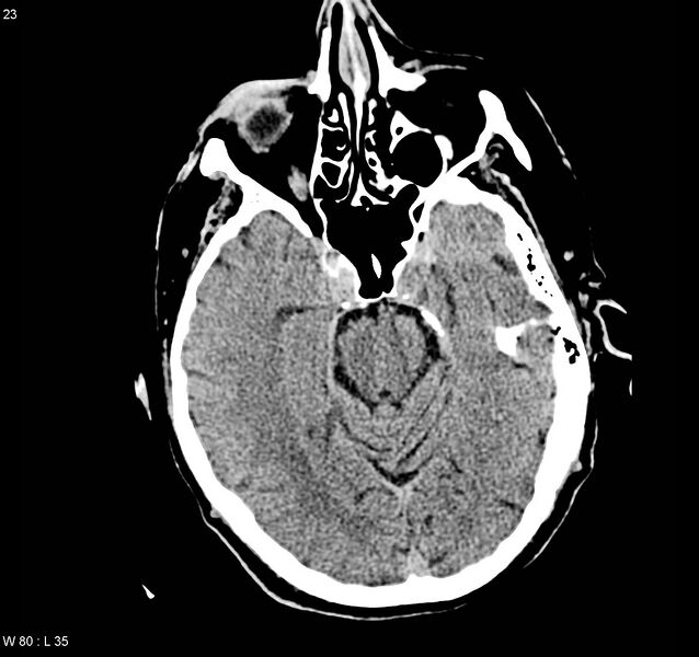 File:Arteriovenous malformation - cerebral (Radiopaedia 8172-9020 Axial non-contrast 6).jpg