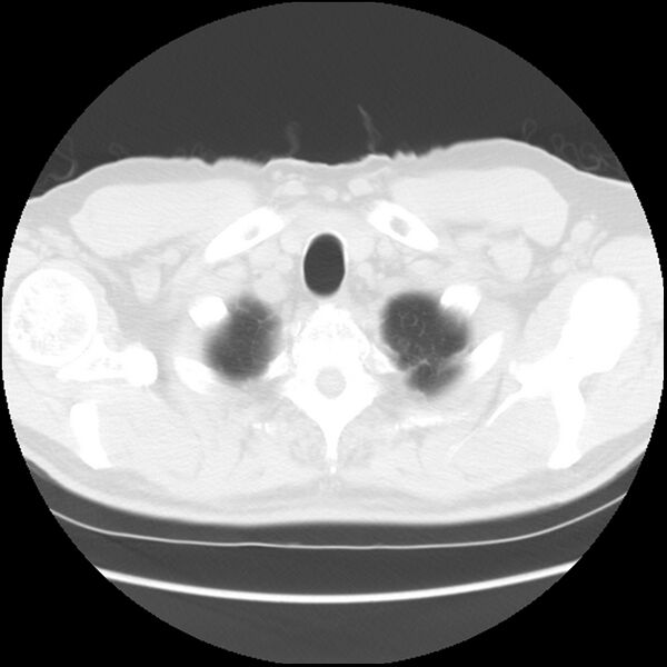 File:Asbestos-related pleural plaques (Radiopaedia 39069-41255 Axial lung window 5).jpg
