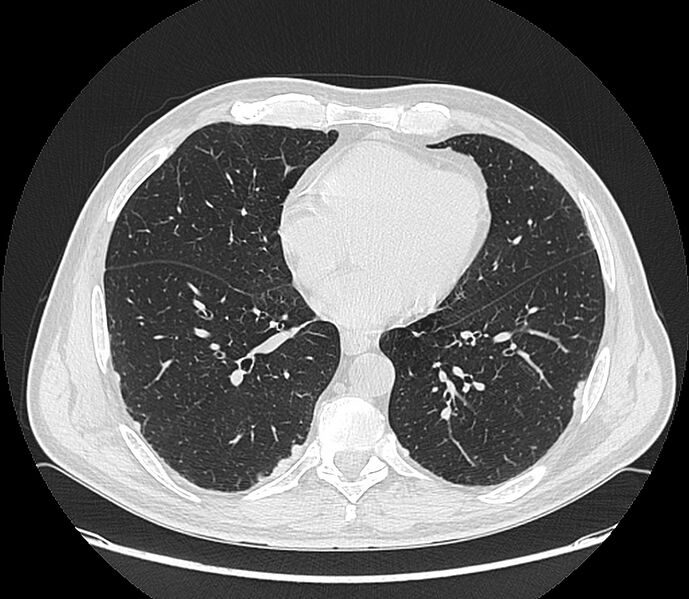 File:Asbestos pleural placques (Radiopaedia 57905-64872 Axial lung window 156).jpg
