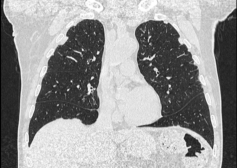 File:Asbestos pleural placques (Radiopaedia 57905-64872 Coronal lung window 115).jpg