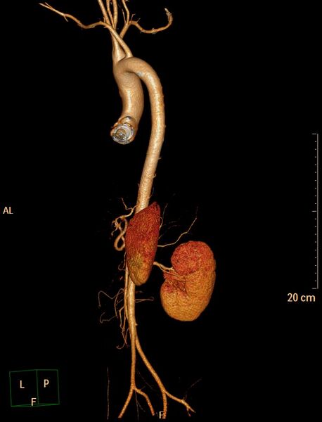 File:Ascending aortic pseudoaneurysm (Radiopaedia 28638-28910 D 22).jpg