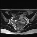 Atypical deep infiltrating endometriosis (Radiopaedia 44470-48125 Axial T2 13).jpg