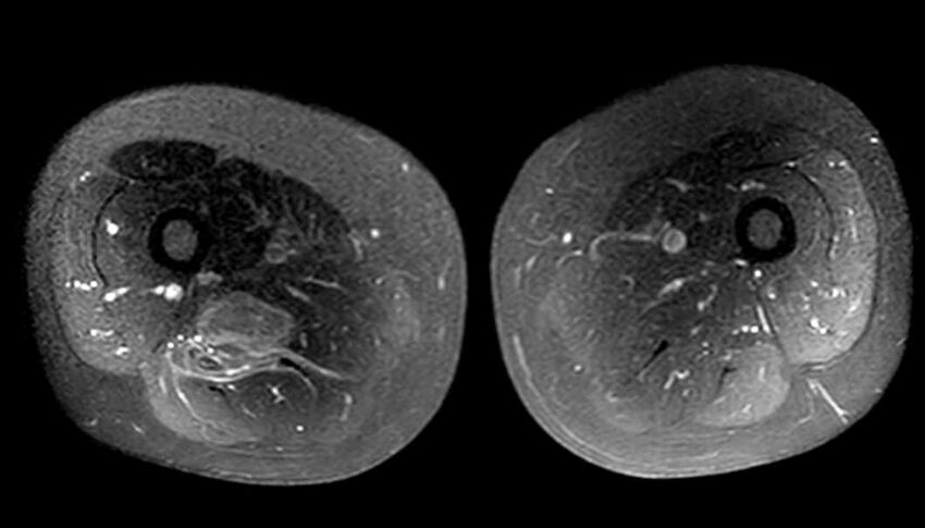 Atypical lipomatous tumor - thigh (Radiopaedia 68975-78734 Axial T1 C+ fat sat 53).jpg