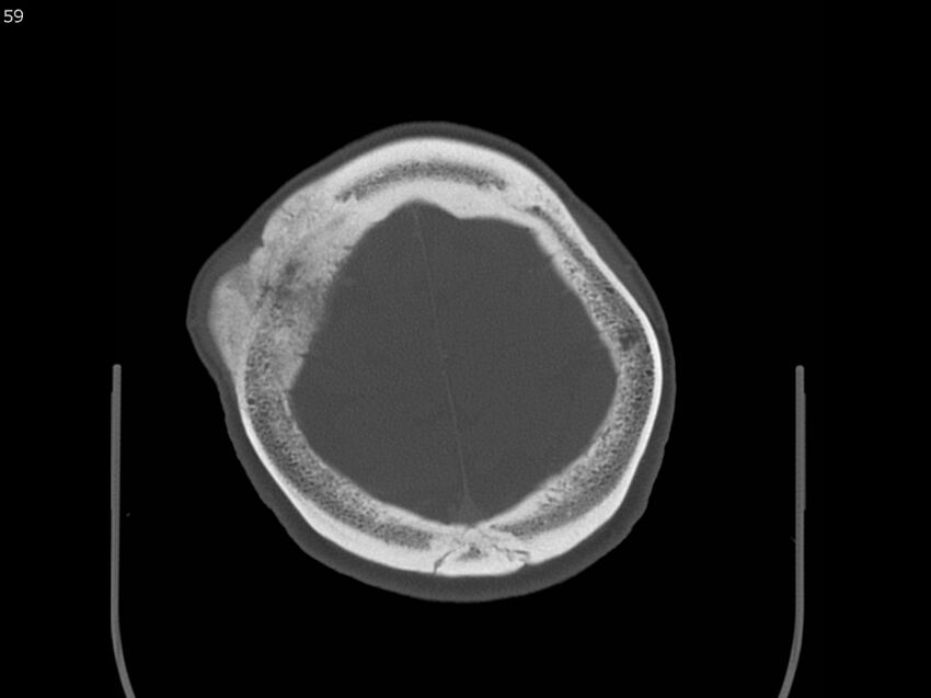 Atypical meningioma - intraosseous (Radiopaedia 64915-73867 Axial C+ bone window 59).jpg