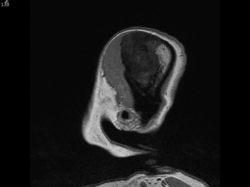 Atypical meningioma - intraosseous (Radiopaedia 64915-74572 Sagittal T1 138).jpg