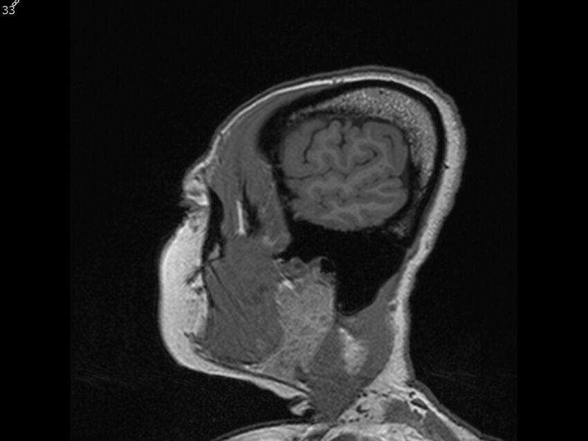 Atypical meningioma - intraosseous (Radiopaedia 64915-74572 Sagittal T1 33).jpg