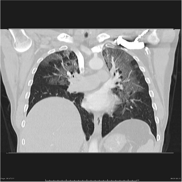 File:Atypical pneumonia - Q fever (Radiopaedia 21993-21989 C 21).jpg