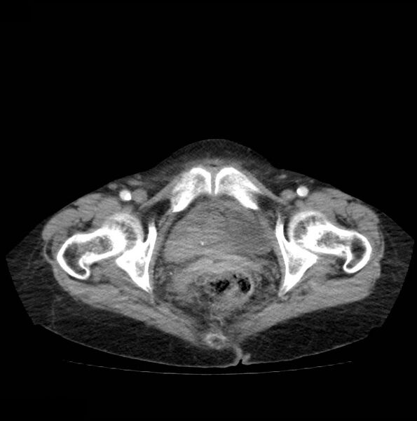 File:Autosomal dominant polycystic kidney disease (Radiopaedia 16777-16490 A 55).jpg