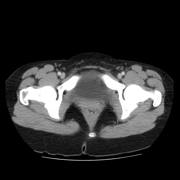 File:Autosomal dominant polycystic kidney disease (Radiopaedia 23061-23093 C 71).jpg