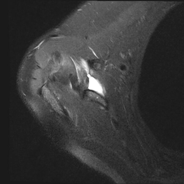 File:Avulsion fracture - greater tuberosity of humerus (Radiopaedia 71216-81515 Axial PD fat sat 14).jpg