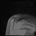 Avulsion fracture - greater tuberosity of humerus (Radiopaedia 71216-81515 Coronal T2 2).jpg