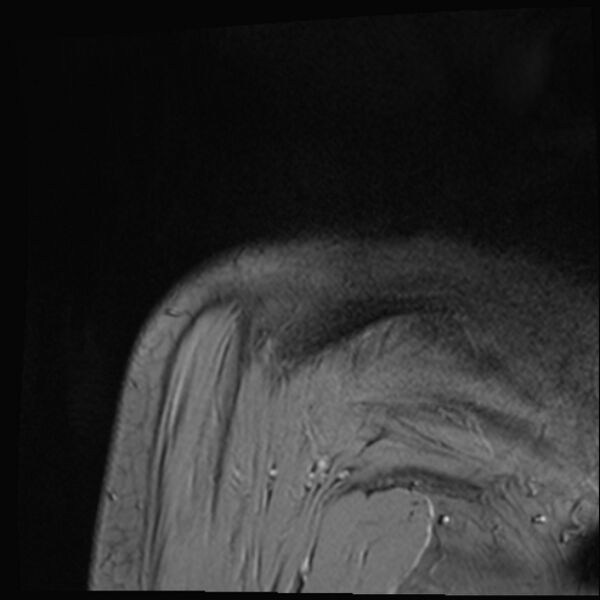 File:Avulsion fracture - greater tuberosity of humerus (Radiopaedia 71216-81515 Coronal T2 2).jpg