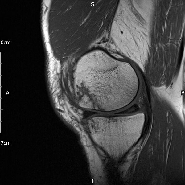 File:Avulsion fracture of the fibular head (Radiopaedia 74804-85808 D 10).jpg