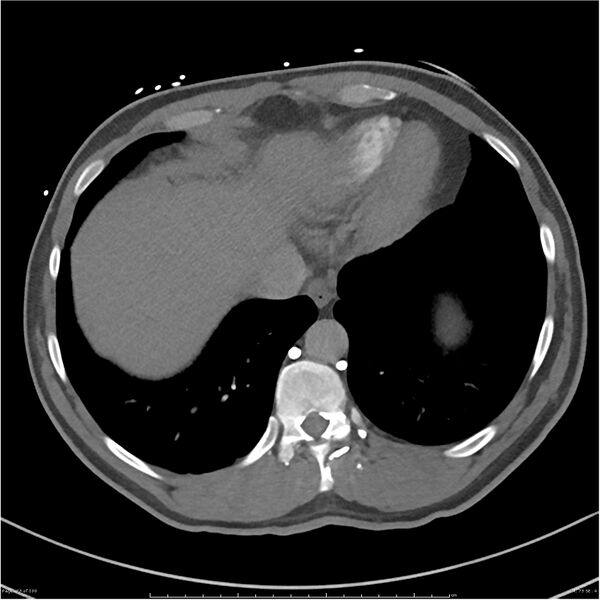 File:Azygos venous system anatomy (CT pulmonary angiography) (Radiopaedia 25928-26077 Axial C+ CTPA 73).jpg