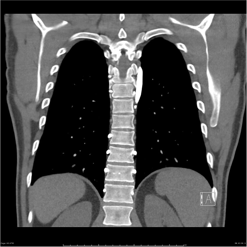 Azygos venous system anatomy (CT pulmonary angiography) (Radiopaedia 25928-26077 Coronal C+ CTPA 60).jpg