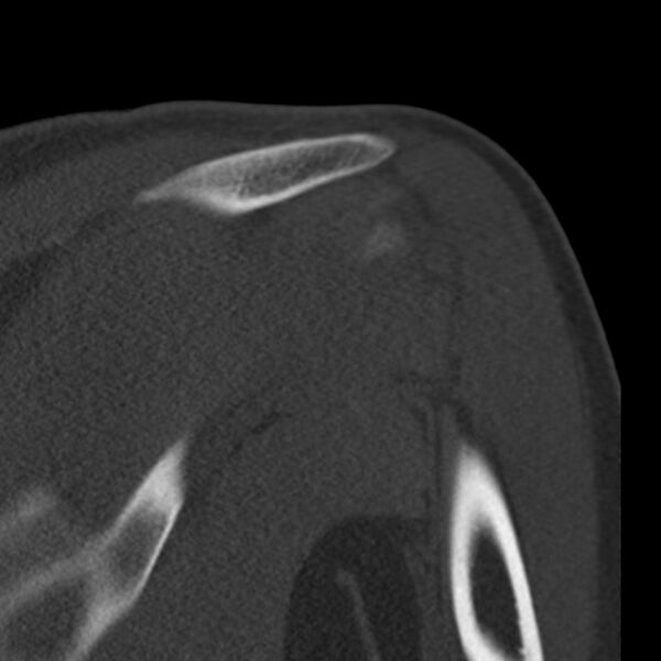 File:Bankart lesion (Radiopaedia 22771-22798 Coronal bone window 34).jpg