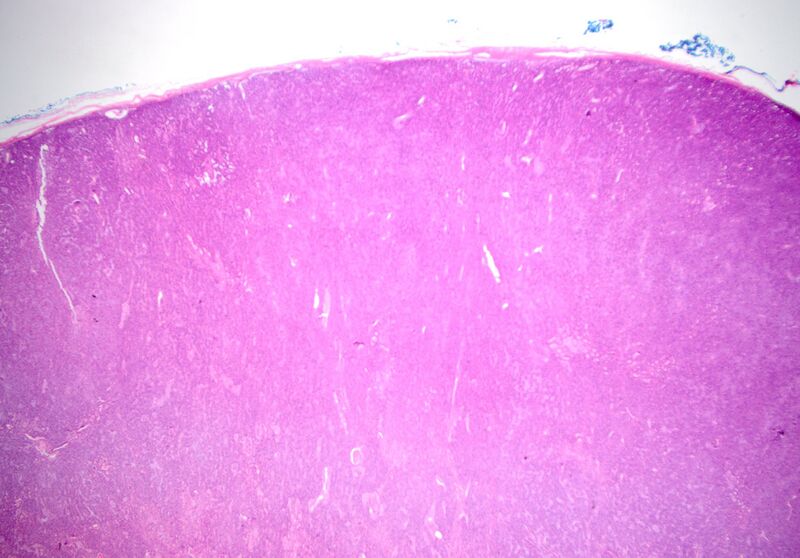 File:Basal cell adenoma - salivary gland (Radiopaedia 43989-47511 20x H&E 1).jpg