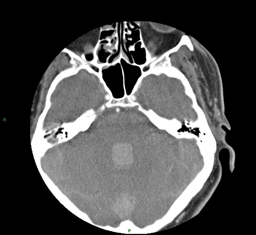 Basal ganglia hemorrhage (Radiopaedia 58763-65985 D 56).jpg