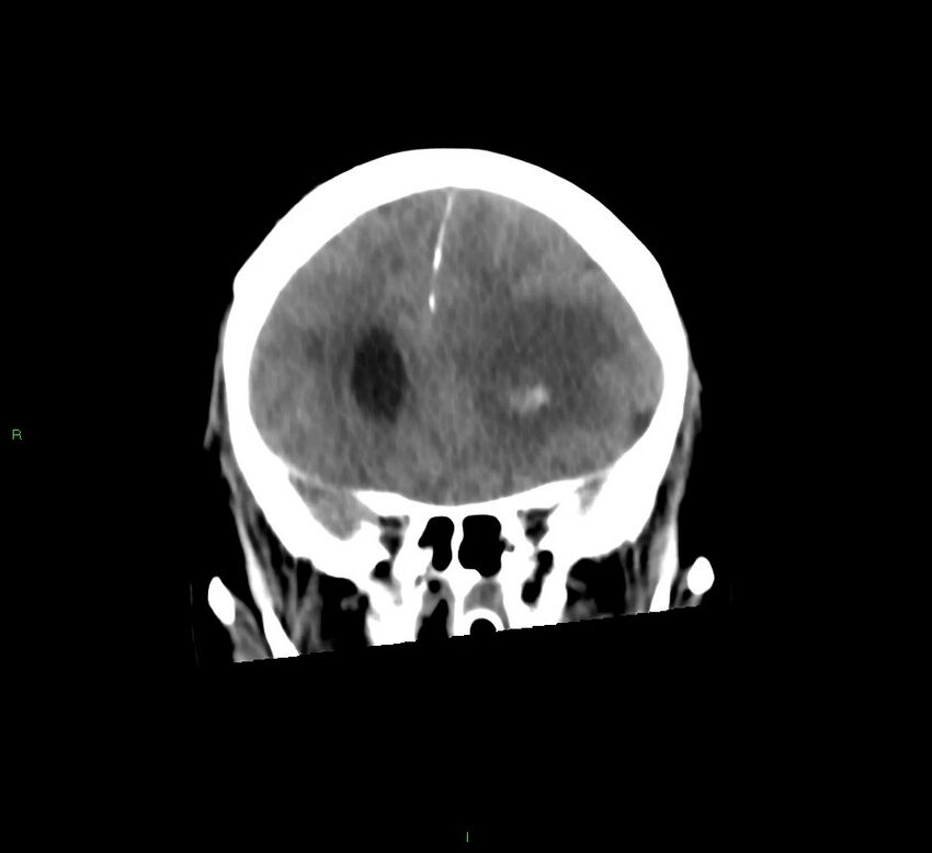 Basal ganglia hemorrhage (Radiopaedia 58775-66008 Coronal non-contrast 46).jpg