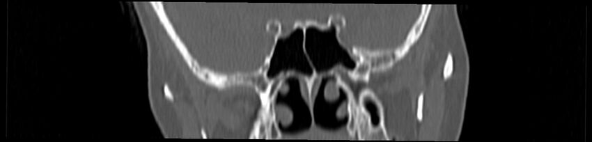 Basilar impression (Radiopaedia 52411-58522 Coronal bone window 6).jpg