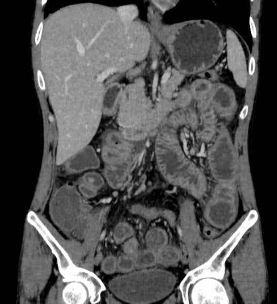 File:Behçet's disease- abdominal vasculitis (Radiopaedia 55955-62570 B 25).jpg