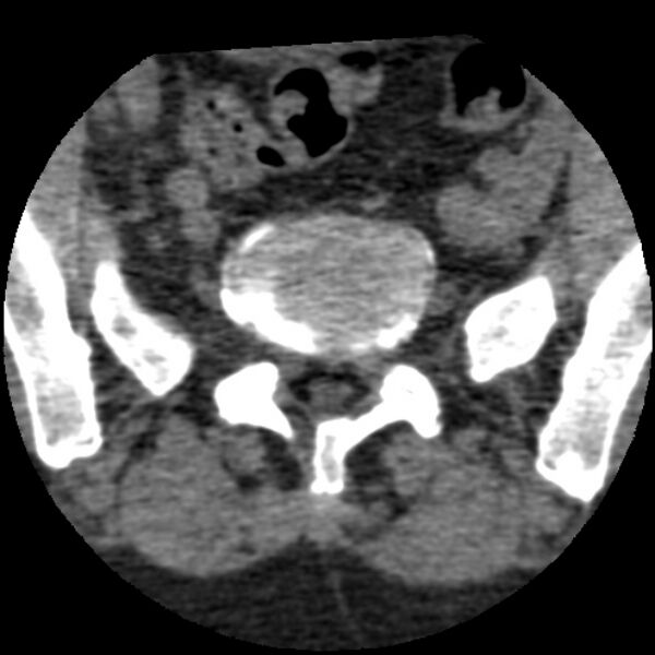 File:Bertolotti syndrome (Radiopaedia 24864-25128 Axial non-contrast 18).jpg