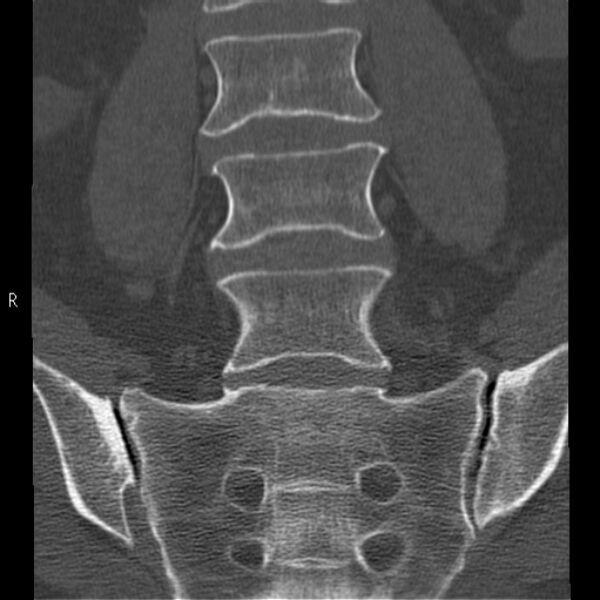 File:Bertolotti syndrome (Radiopaedia 24864-25128 Coronal bone window 18).jpg