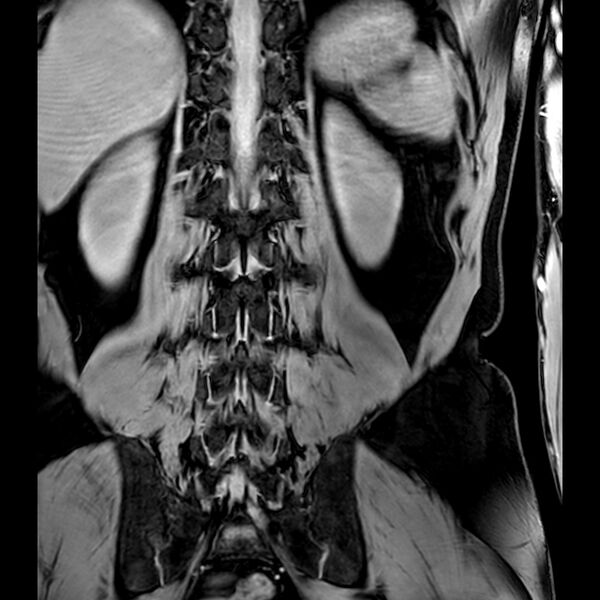 File:Bilateral conjoined nerve roots at different levels (Radiopaedia 73312-84063 B 37).jpg