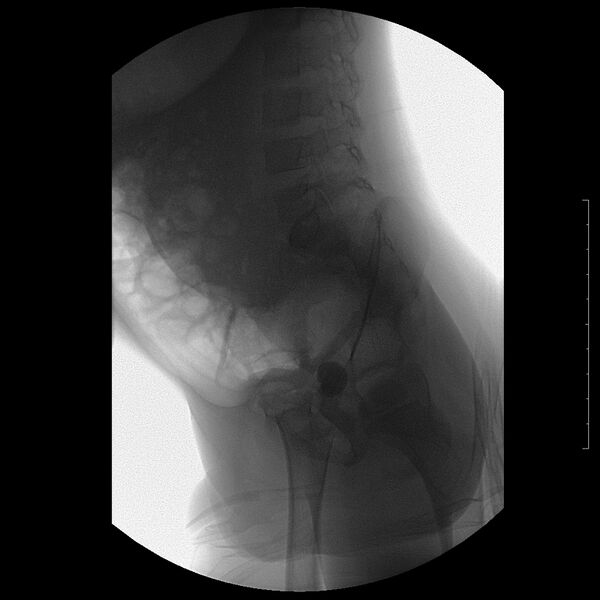 File:Bilateral duplex kidneys with left-sided uterocoele (Radiopaedia 20811-20726 A 6).jpg