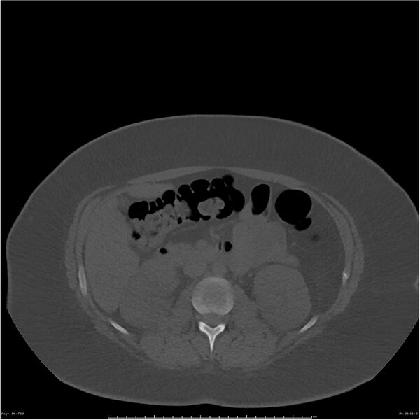 File:Bilateral lumbar ribs (Radiopaedia 25862-26010 bone window 16).jpg