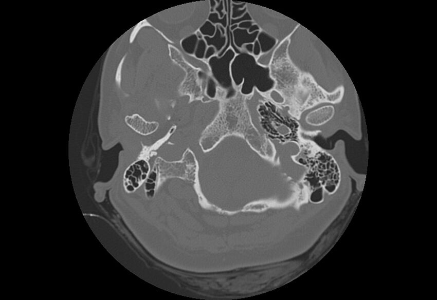 Bilateral otospongiosis (Radiopaedia 35447-36940 B 9).jpg