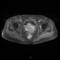 Bilateral ovarian fibroma (Radiopaedia 44568-48293 Axial T1 C+ fat sat 20).jpg