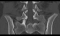 Bilateral pars defect (Radiopaedia 26691-26846 Coronal bone window 28).jpg