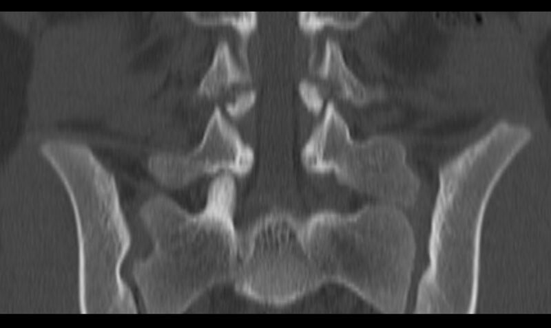 File:Bilateral pars defect (Radiopaedia 26691-26846 Coronal bone window 28).jpg