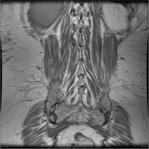 File:Bilateral psoas hematomas (Radiopaedia 24057-24280 B 3).jpg