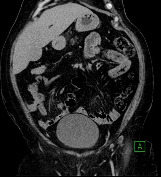 File:Bilateral sporadic synchronous clear cell renal cell carcinoma (Radiopaedia 85035-100575 I 9).jpg