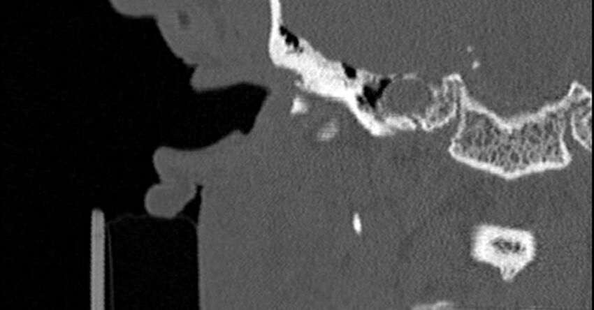 Bilateral temporal bone fractures (Radiopaedia 29482-29970 Coronal non-contrast 76).jpg