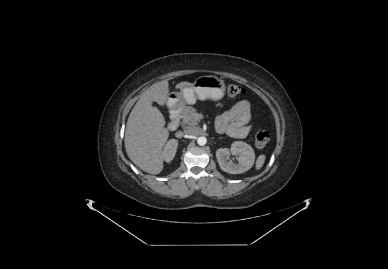 File:Bilateral urolithiasis with incidentally detected splenic artery aneurysm and left inferior vena cava (Radiopaedia 44467-48127 A 29).jpg