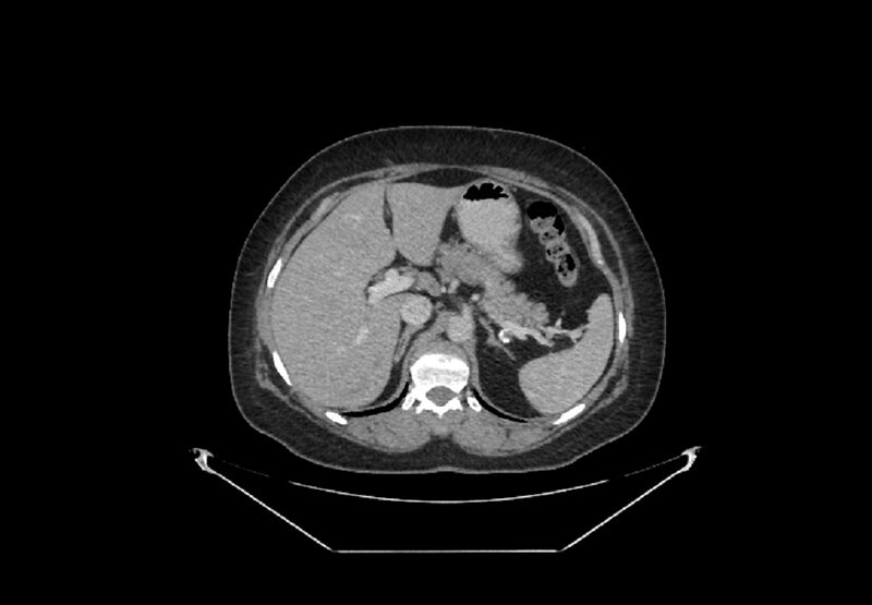 File:Bilateral urolithiasis with incidentally detected splenic artery aneurysm and left inferior vena cava (Radiopaedia 44467-48127 B 12).jpg